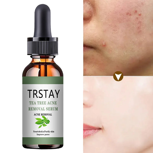 Advanced Acne Treatment Face Serum with Tea Tree Oil - Moisturizing Essence for Shrinking Pores and Clearer Skin