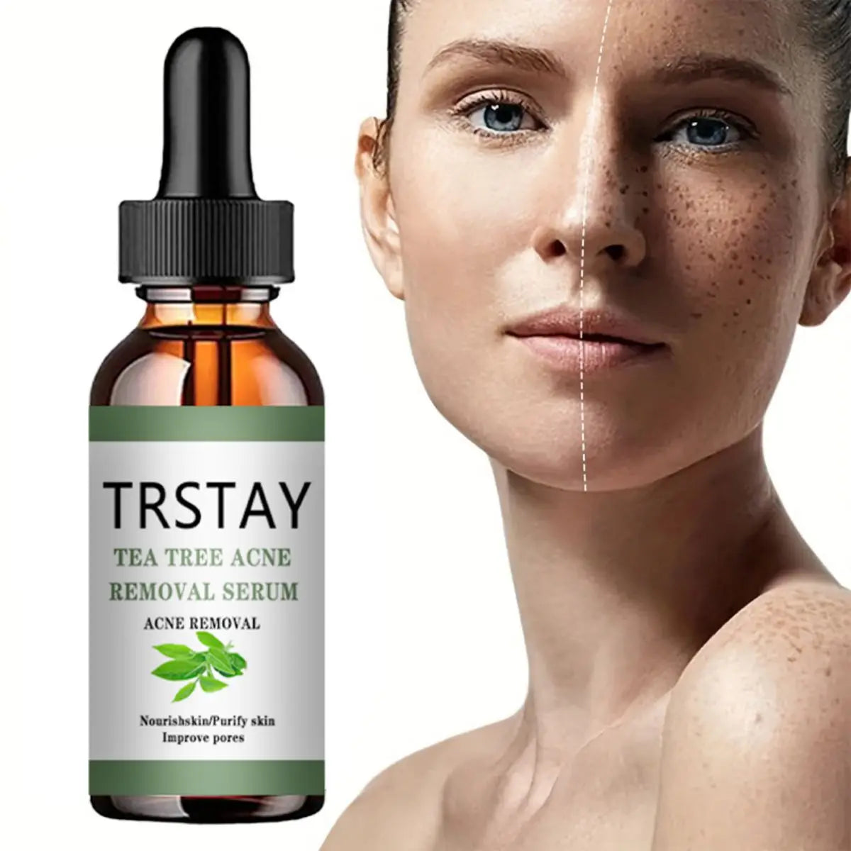 Advanced Acne Treatment Face Serum with Tea Tree Oil - Moisturizing Essence for Shrinking Pores and Clearer Skin
