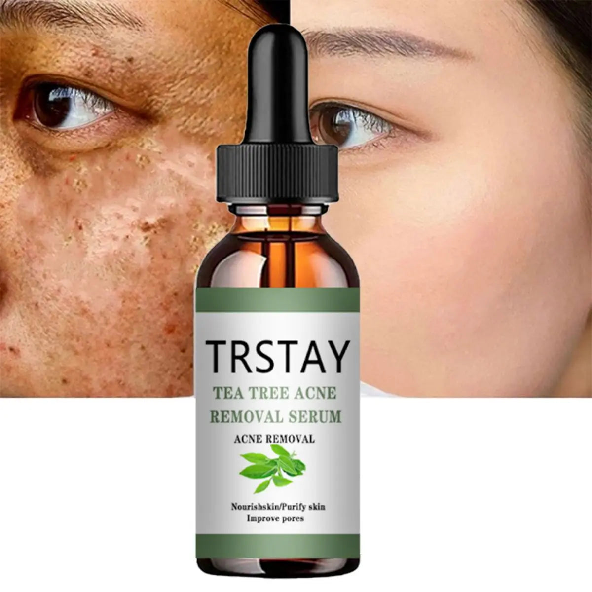 Advanced Acne Treatment Face Serum with Tea Tree Oil - Moisturizing Essence for Shrinking Pores and Clearer Skin