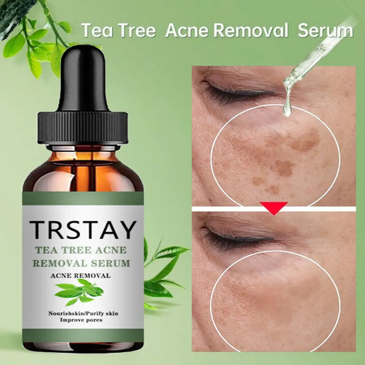 Advanced Acne Treatment Face Serum with Tea Tree Oil - Moisturizing Essence for Shrinking Pores and Clearer Skin