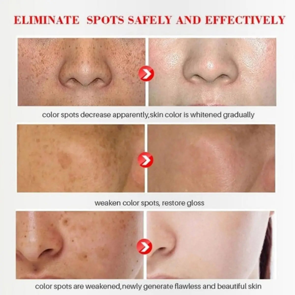 Advanced Acne Treatment Face Serum with Tea Tree Oil - Moisturizing Essence for Shrinking Pores and Clearer Skin
