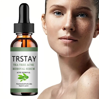 Advanced Acne Treatment Face Serum with Tea Tree Oil - Moisturizing Essence for Shrinking Pores and Clearer Skin