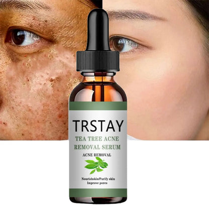 Advanced Acne Treatment Face Serum with Tea Tree Oil - Moisturizing Essence for Shrinking Pores and Clearer Skin